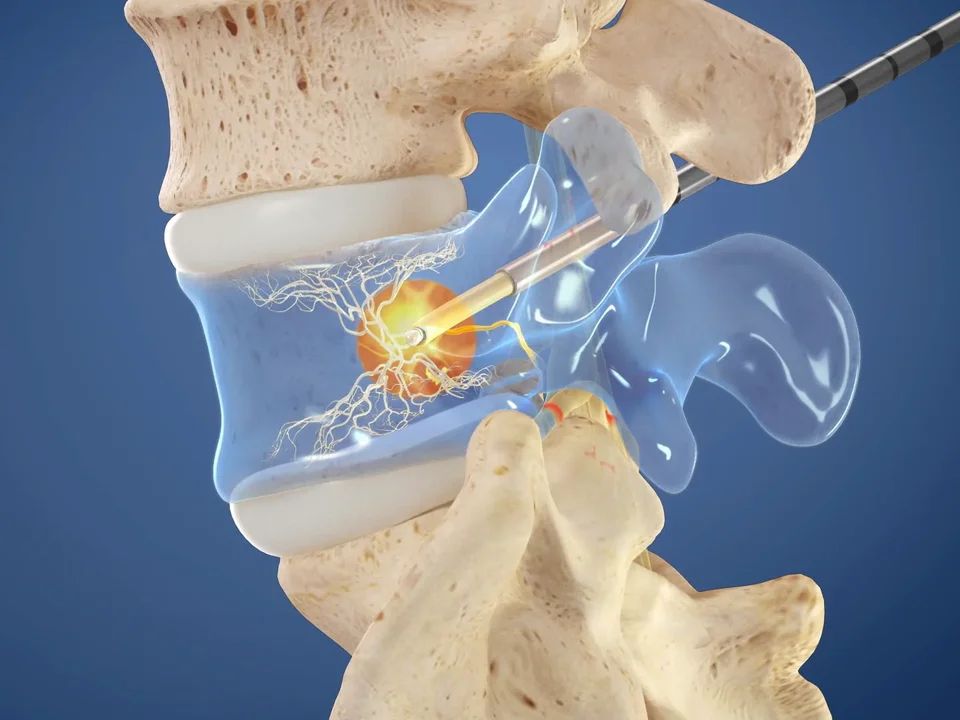 Intracept basivertebral nerve ablation for chronic vertebrogenic low back pain