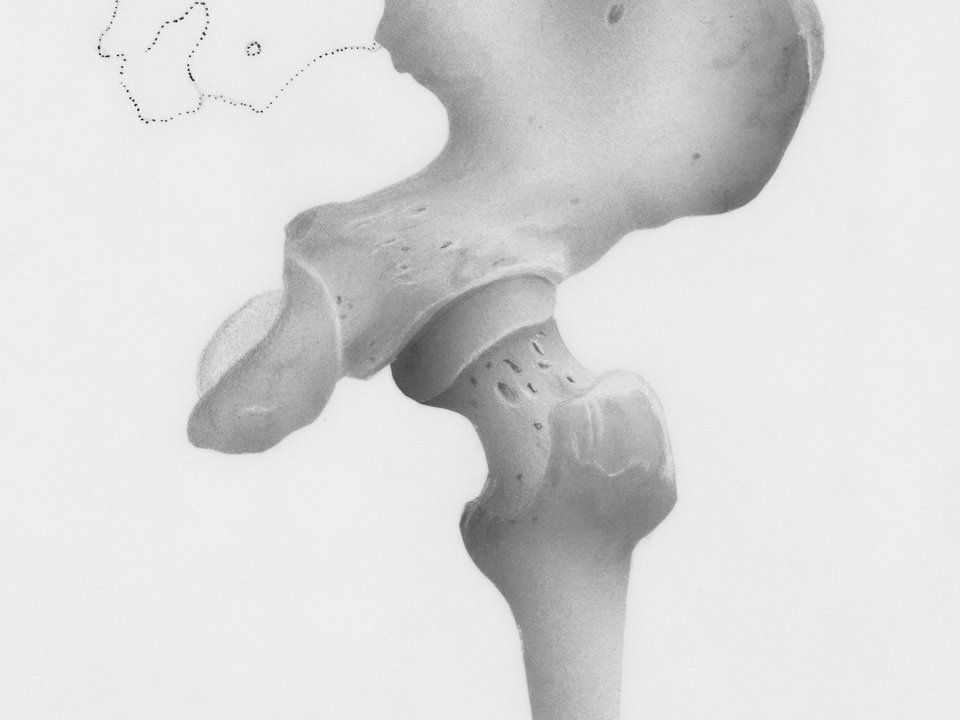 Sacroiliac joint injection for lower back and pelvic pain