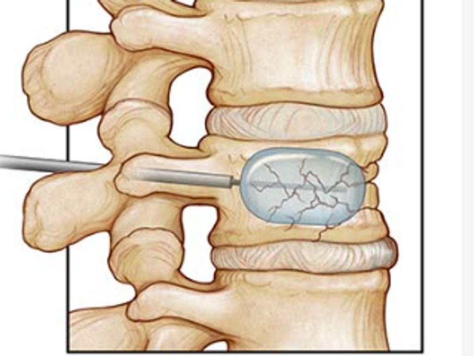 Spinal cord stimulation device implanted for chronic refractory pain relief